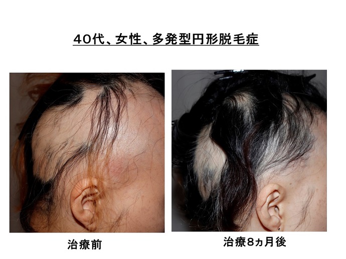 円形脱毛症　病院